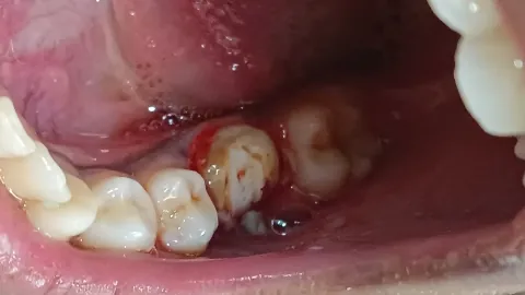Before surgery