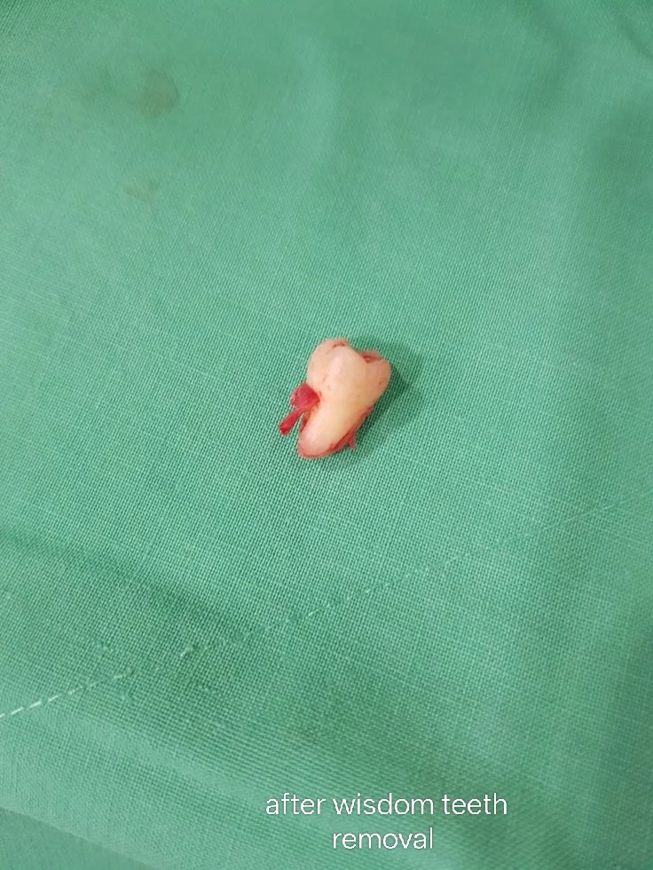 Dental Extractions — after