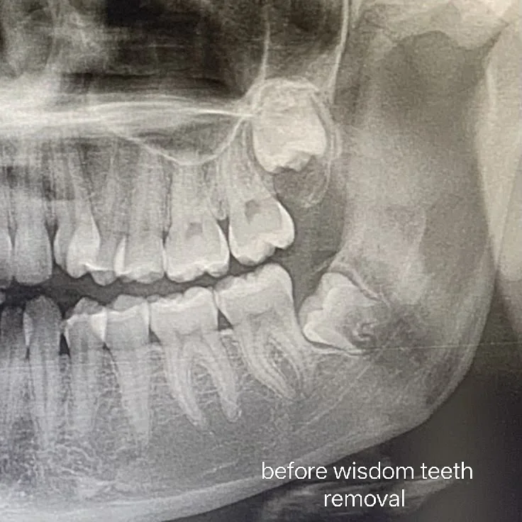 Dental Extractions — before