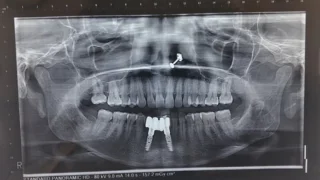 Dental Implants — after