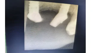 Dental Implants — before
