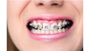 Fixed Orthodontic Appliances — after