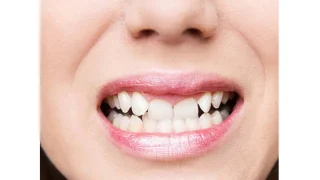 Fixed Orthodontic Appliances — before