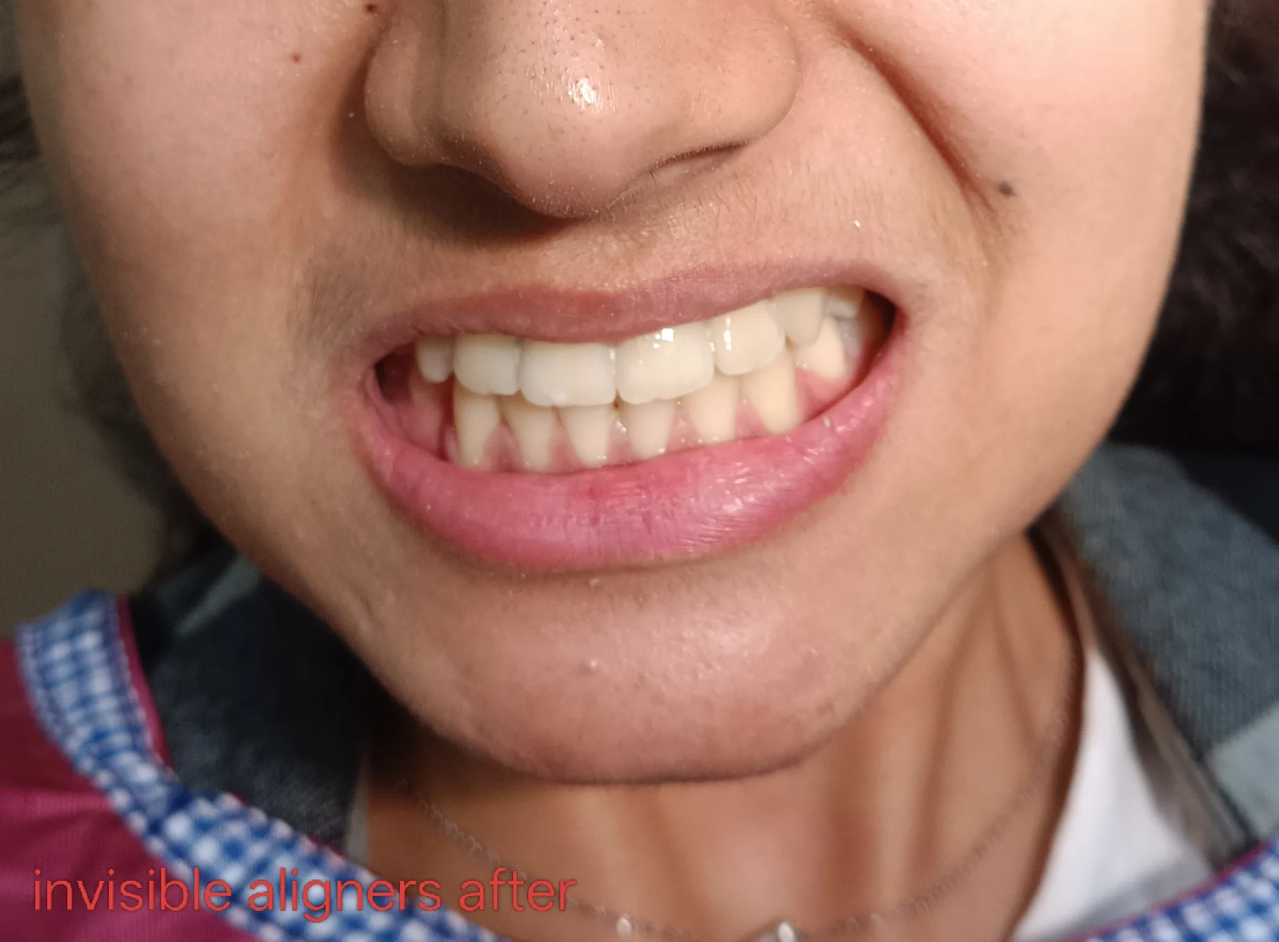 After surgery