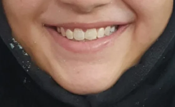 Orthodontics — after