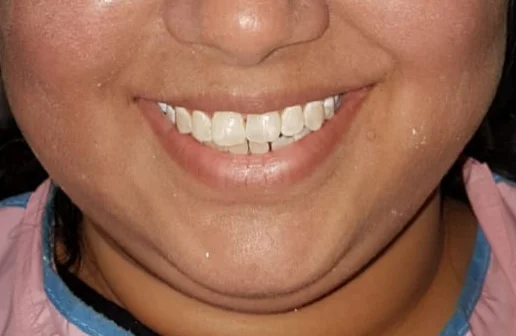Orthodontics — before