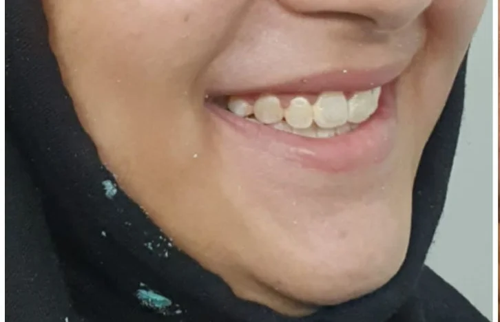 Orthodontics — after