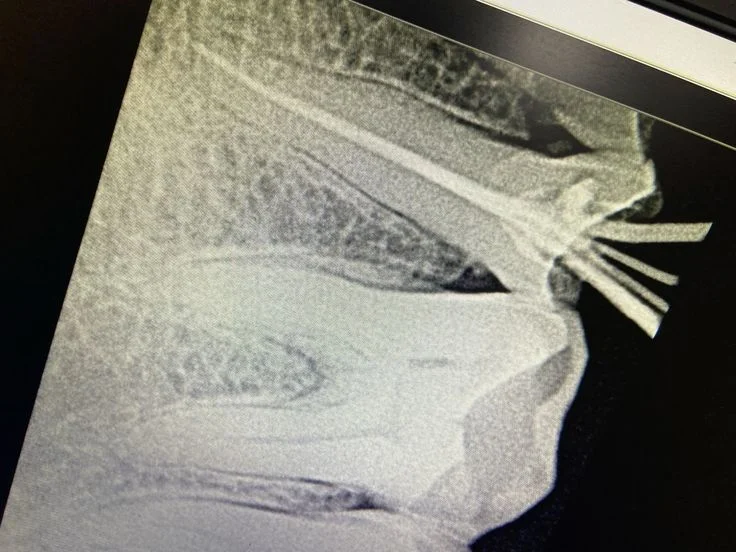 Root Canal Treatment — after