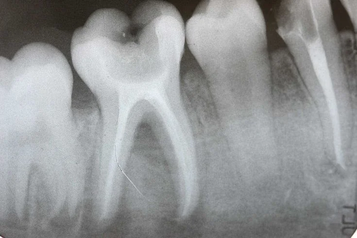 Root Canal Treatment — before