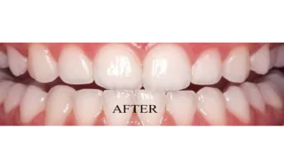 Scaling And Root Planing — after