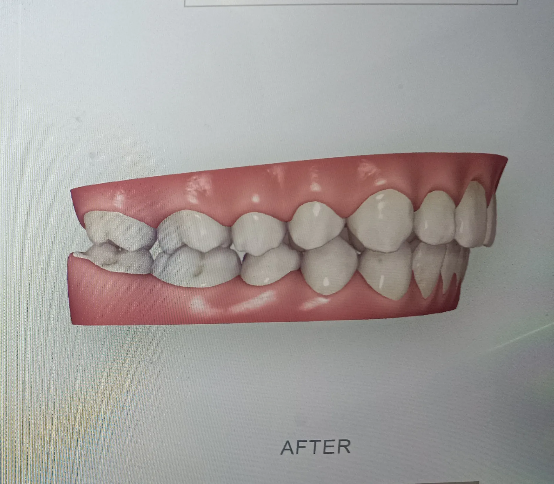 After surgery