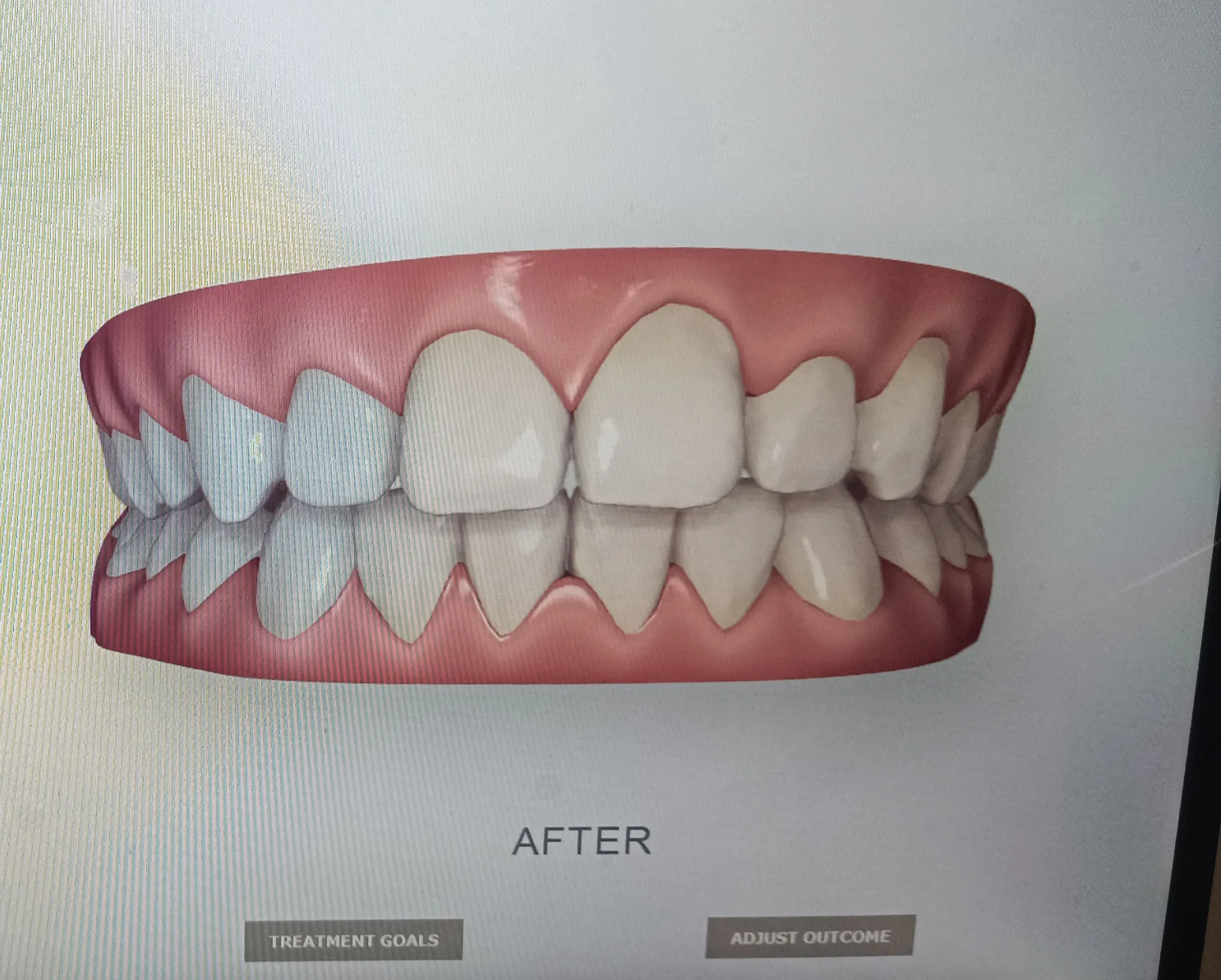 After surgery