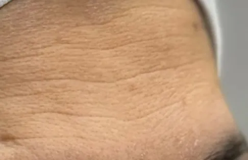 Botox — before