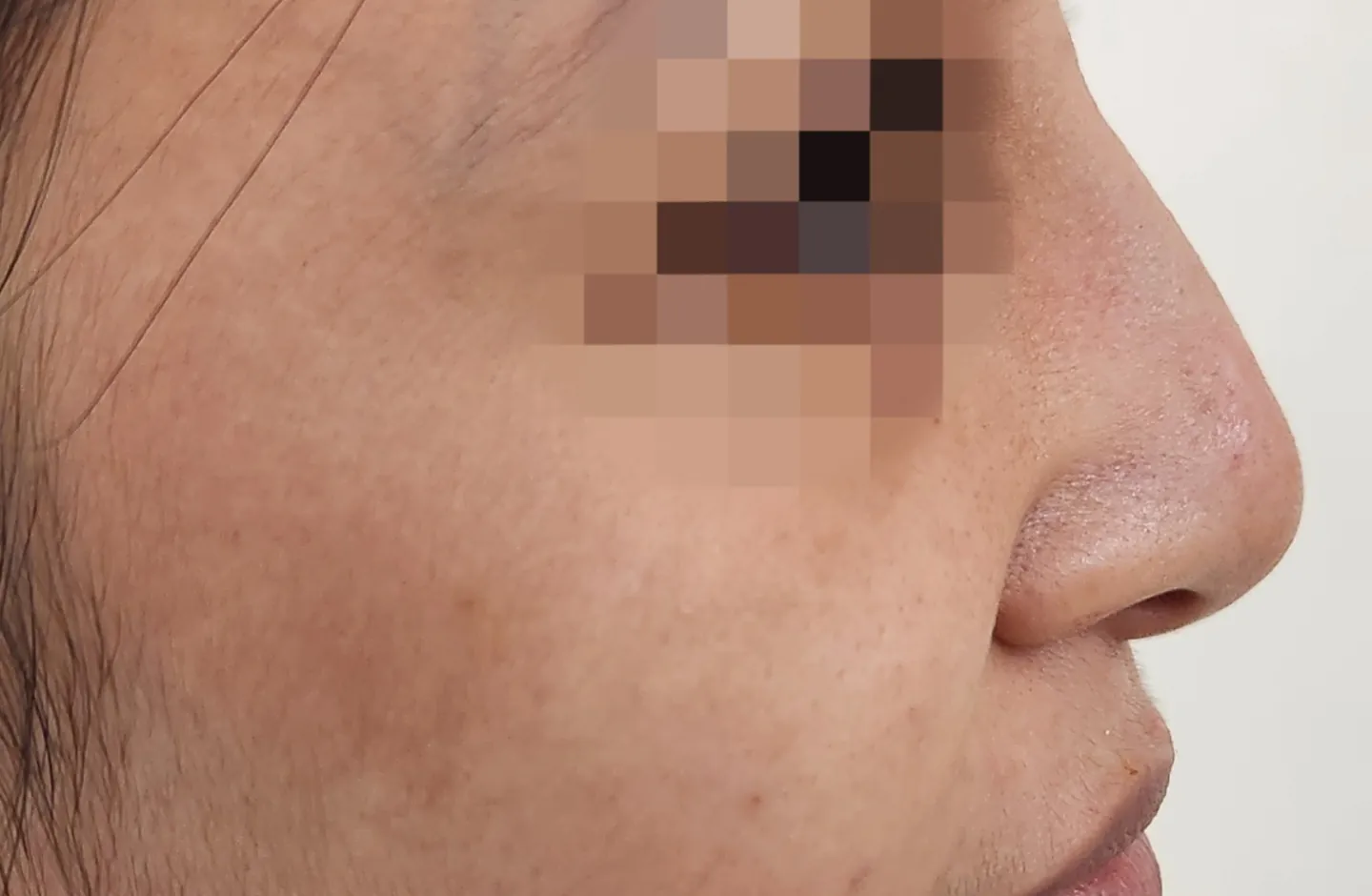 Dermal Fillers — before