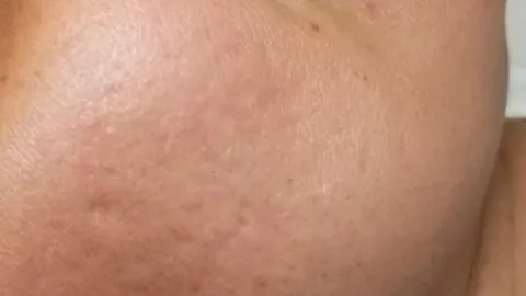 After surgery