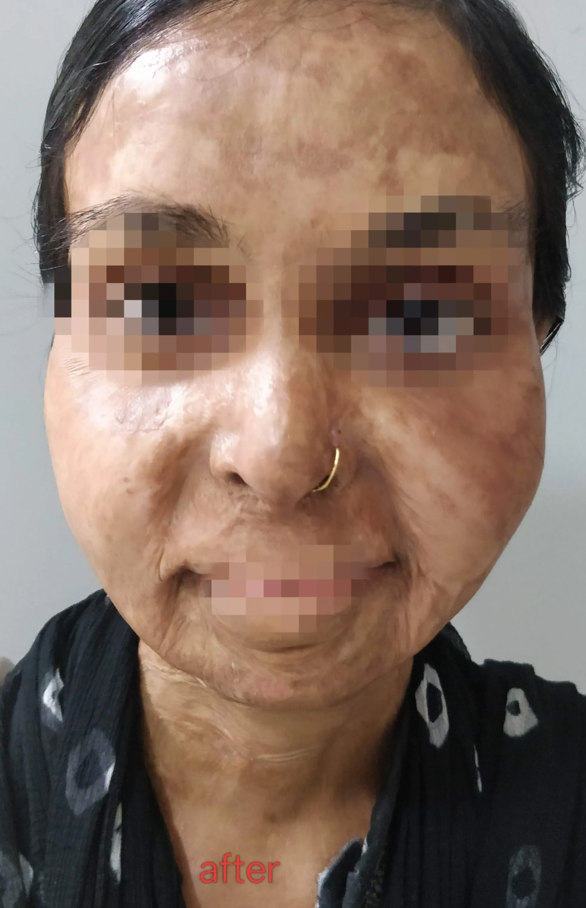 After surgery