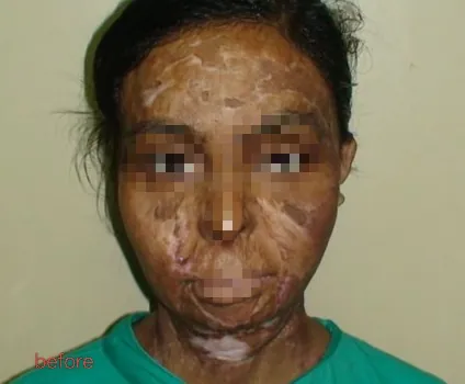 Before surgery