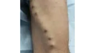 After surgery