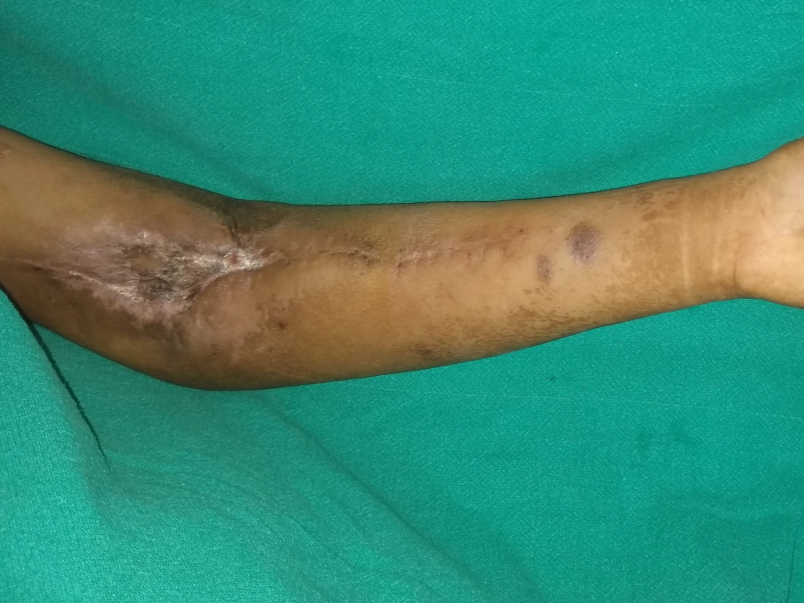 After surgery