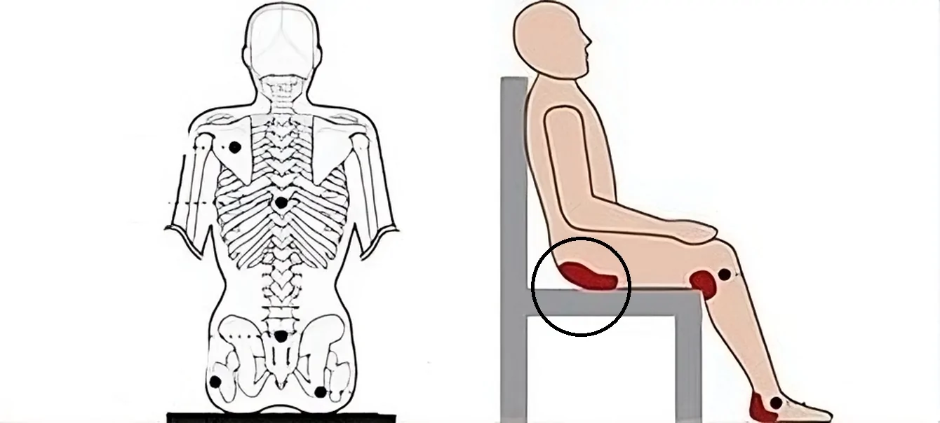 Bedsores over Seat Bone (Ischium) — hero image