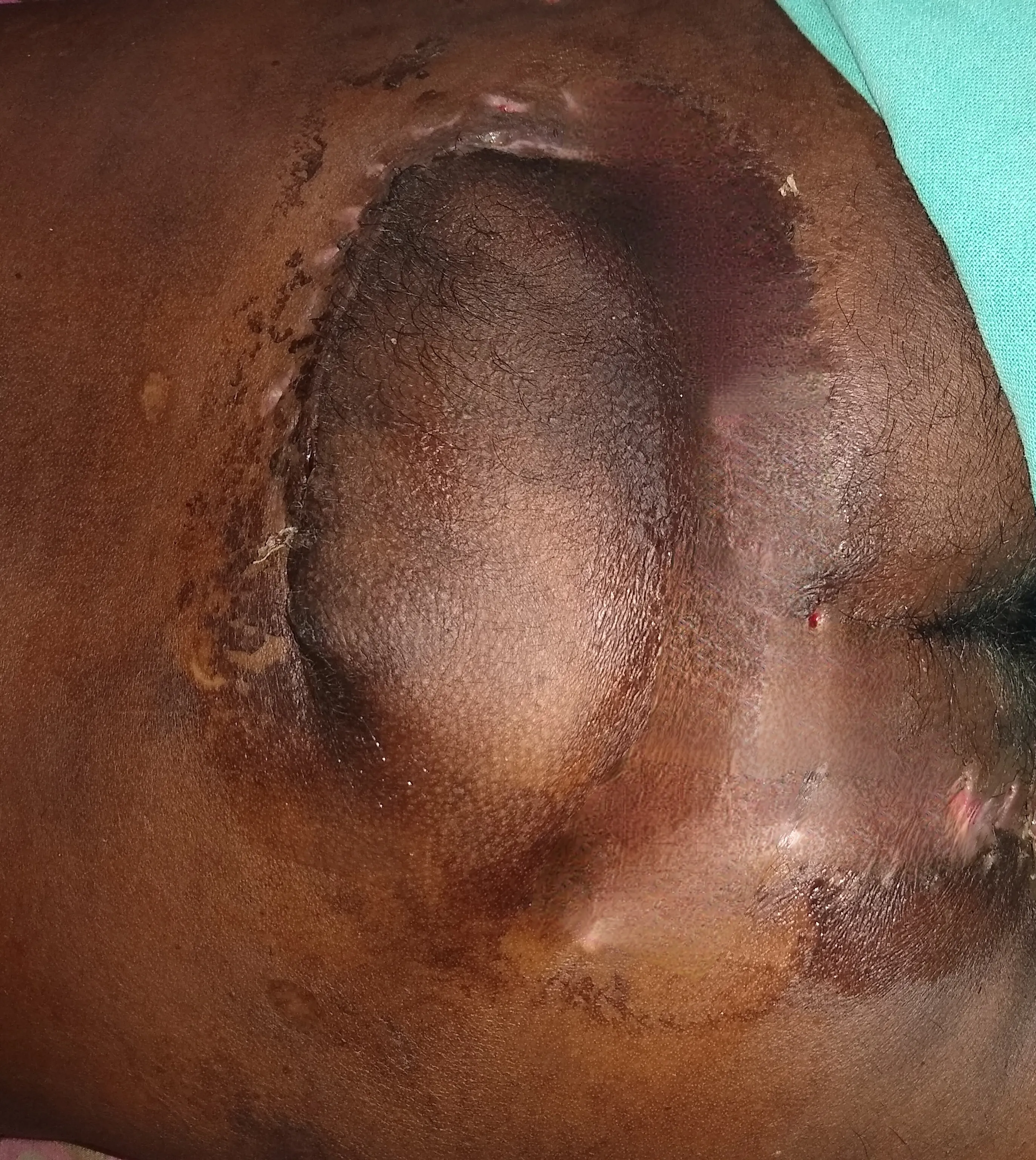 After surgery