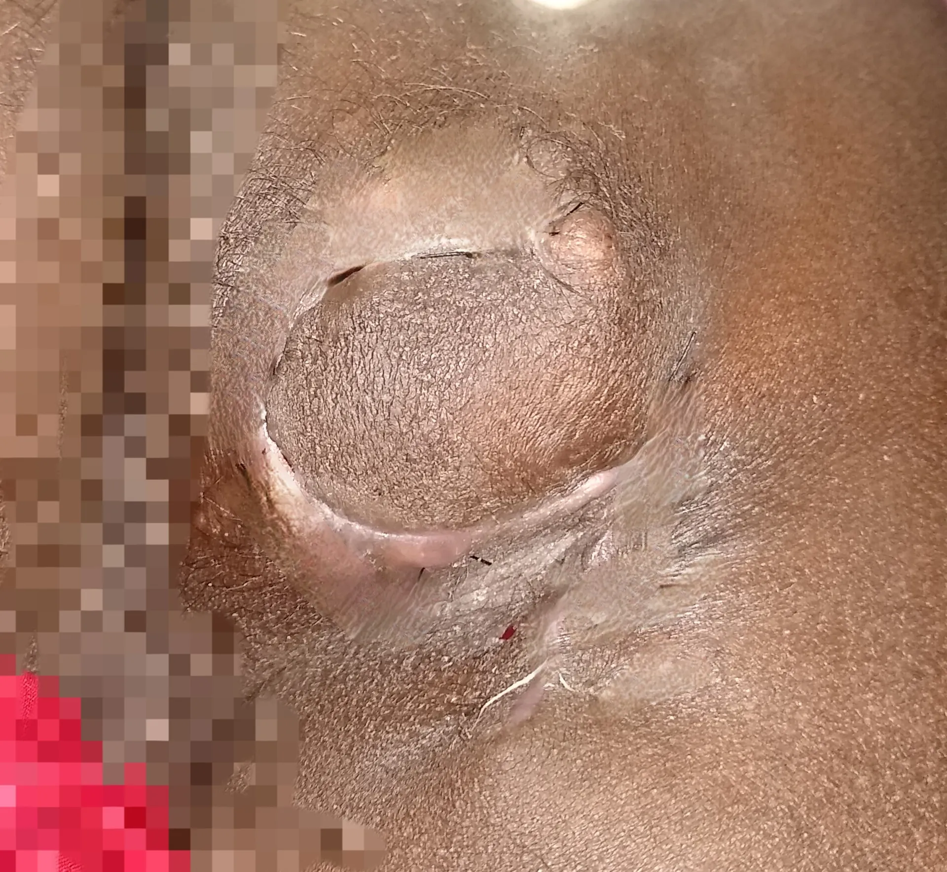 After surgery