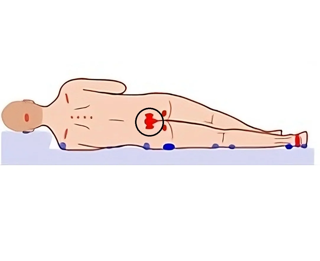 Bedsore over Sacrum (Lower Back) — hero image