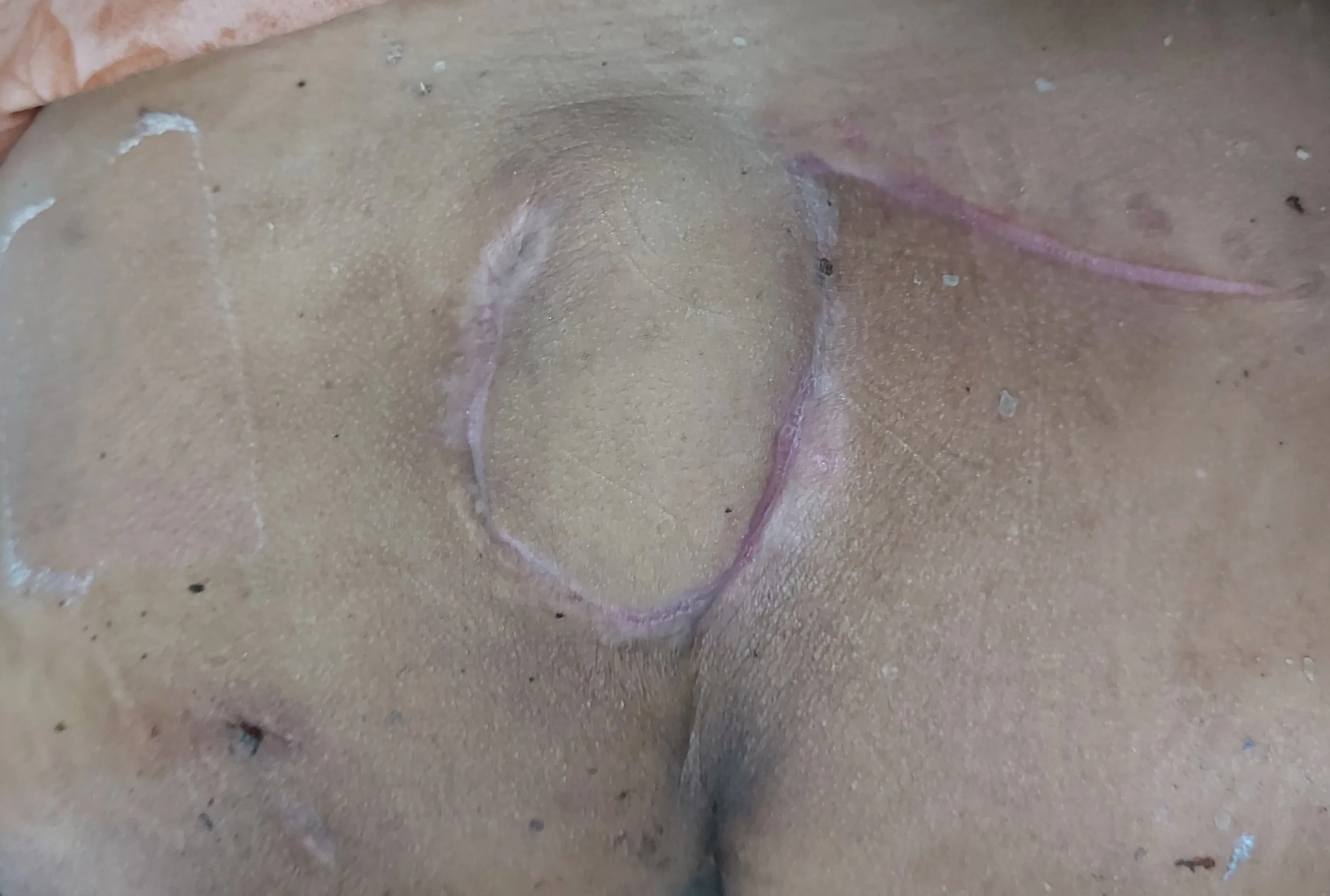 After surgery