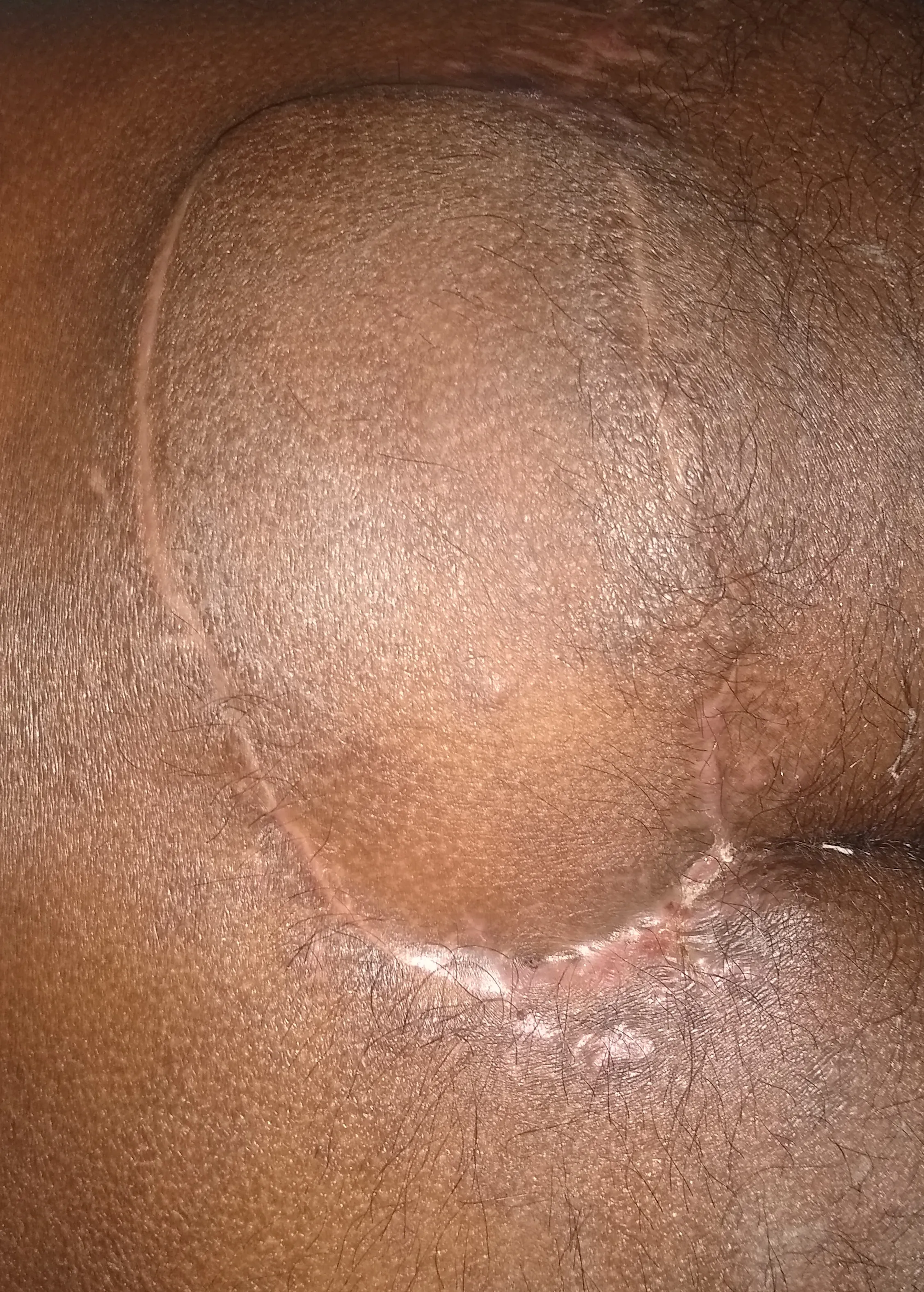 After surgery