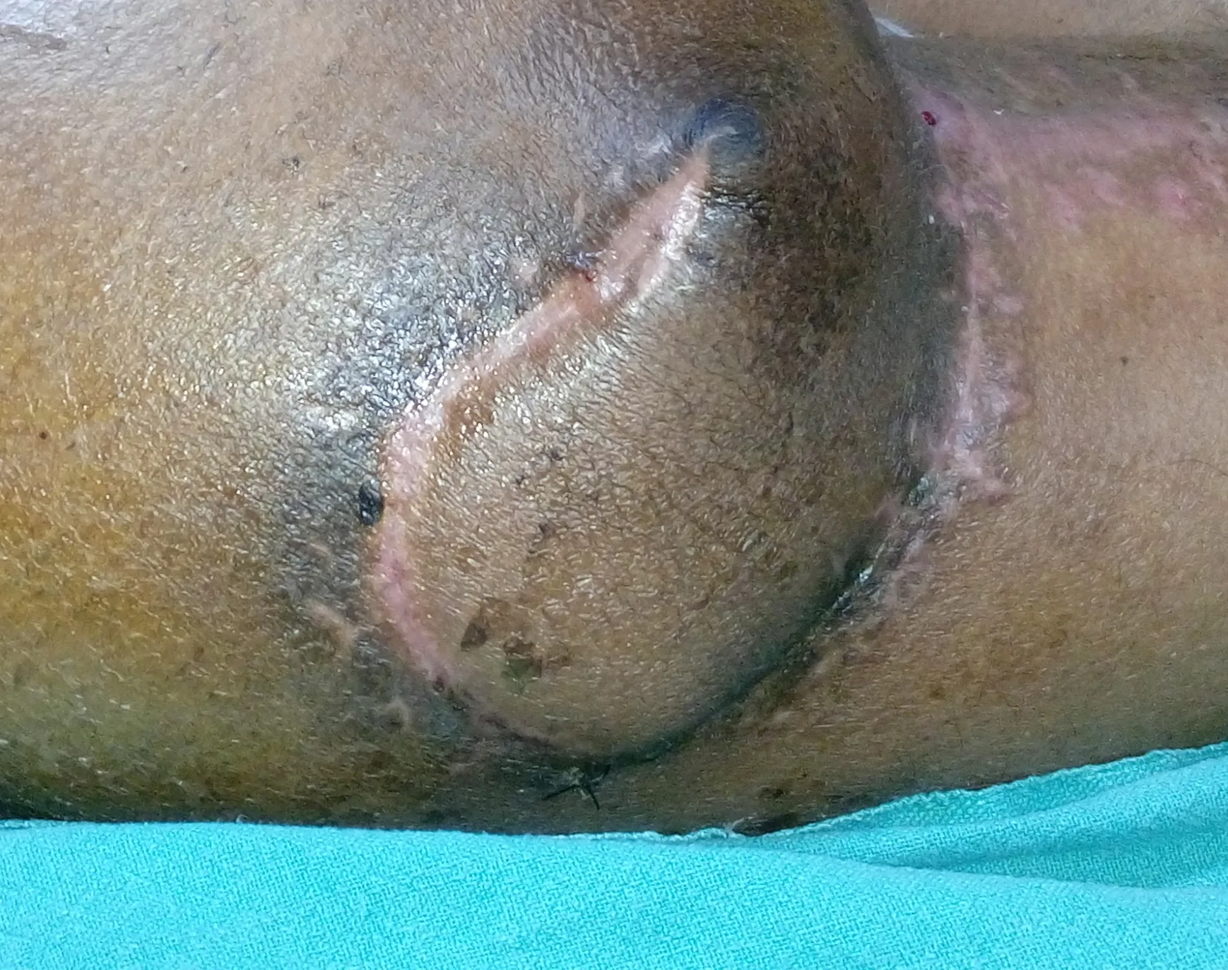 After surgery