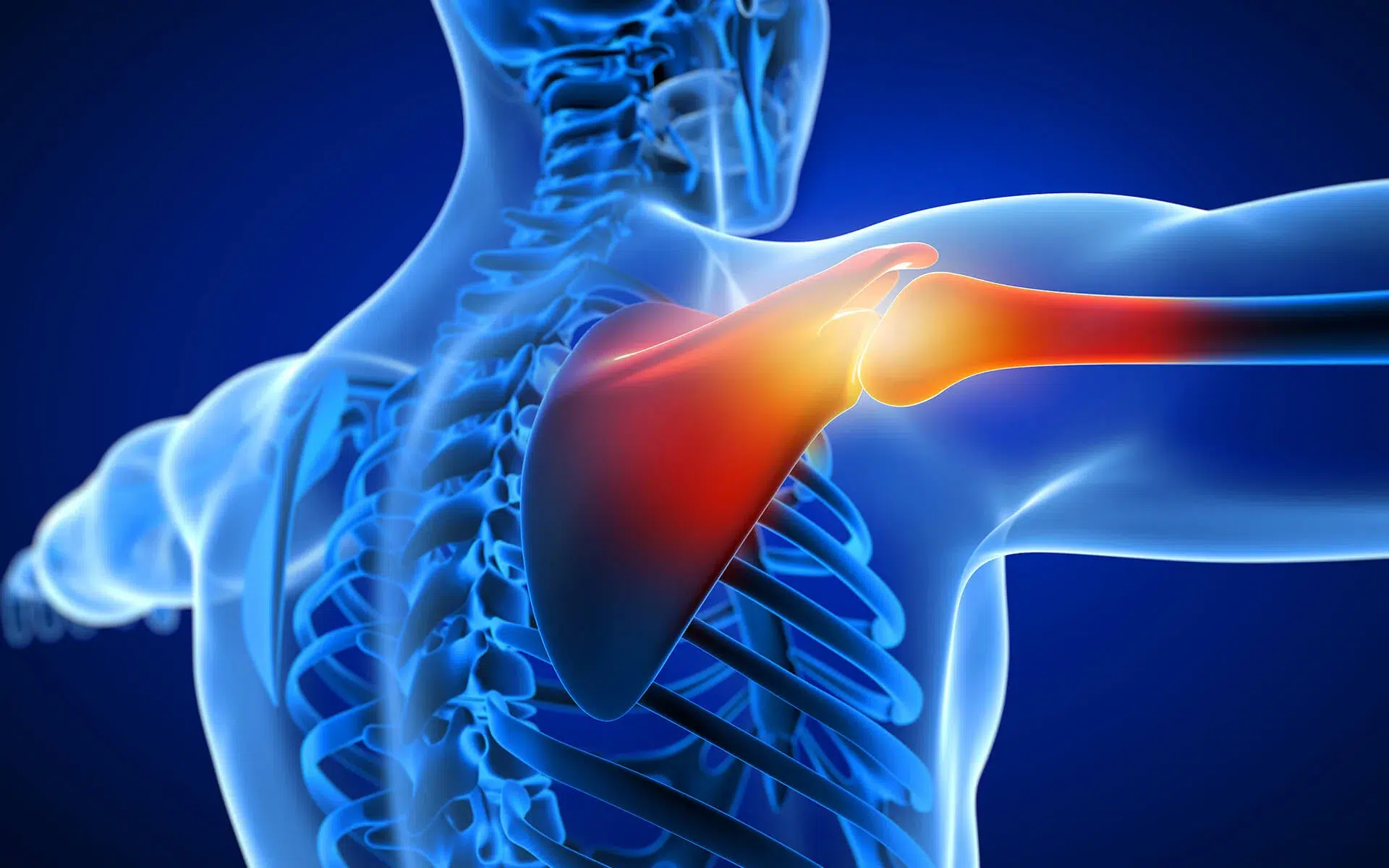 Partial Brachial Plexus Injury — hero image