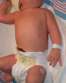 After surgery
