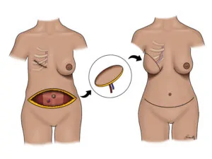 Breast Reconstruction