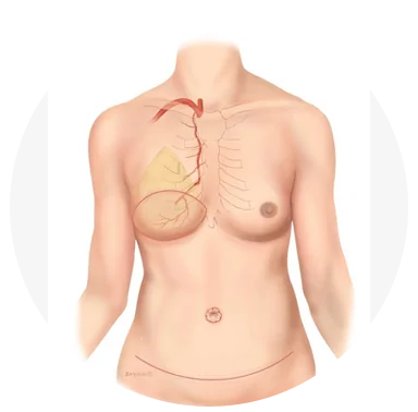 Breast Reconstruction