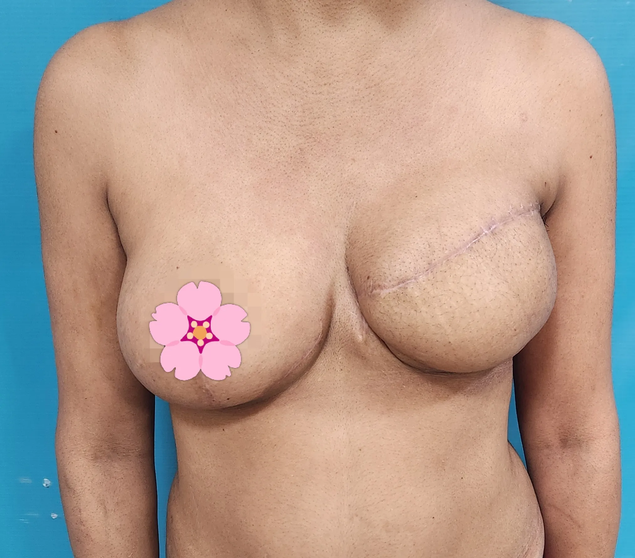 Breast Reconstruction — after