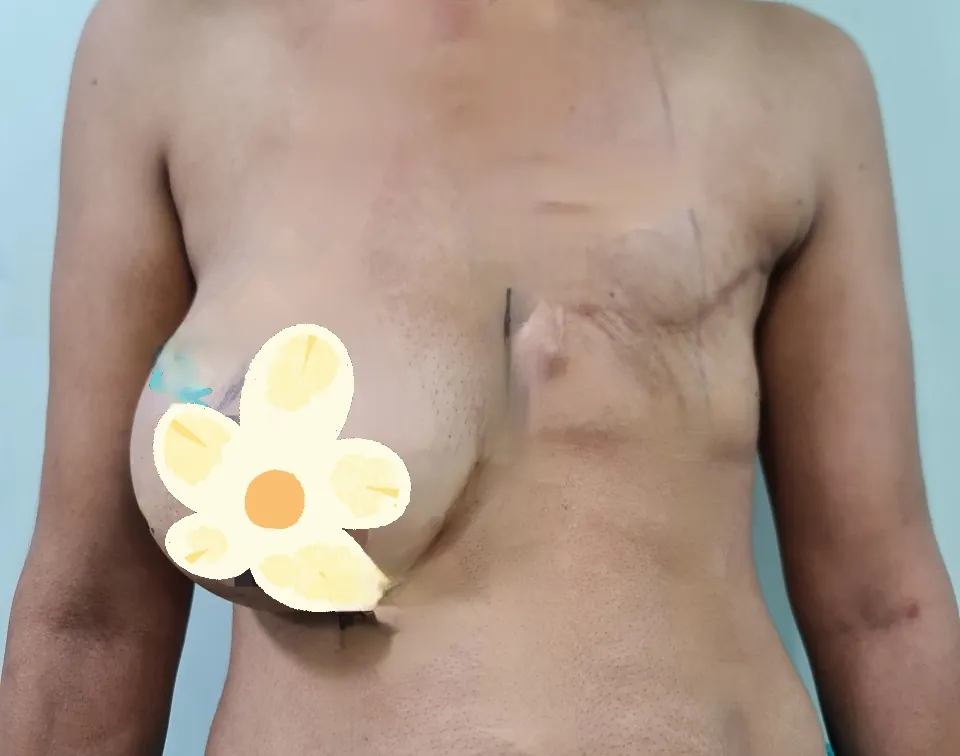 Breast Reconstruction — before