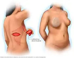 Breast Reconstruction