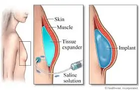 Breast Reconstruction