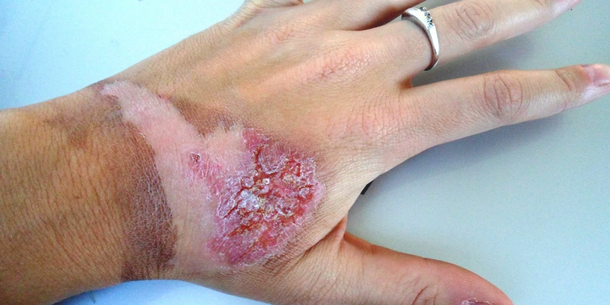 Burn Contractures — hero image