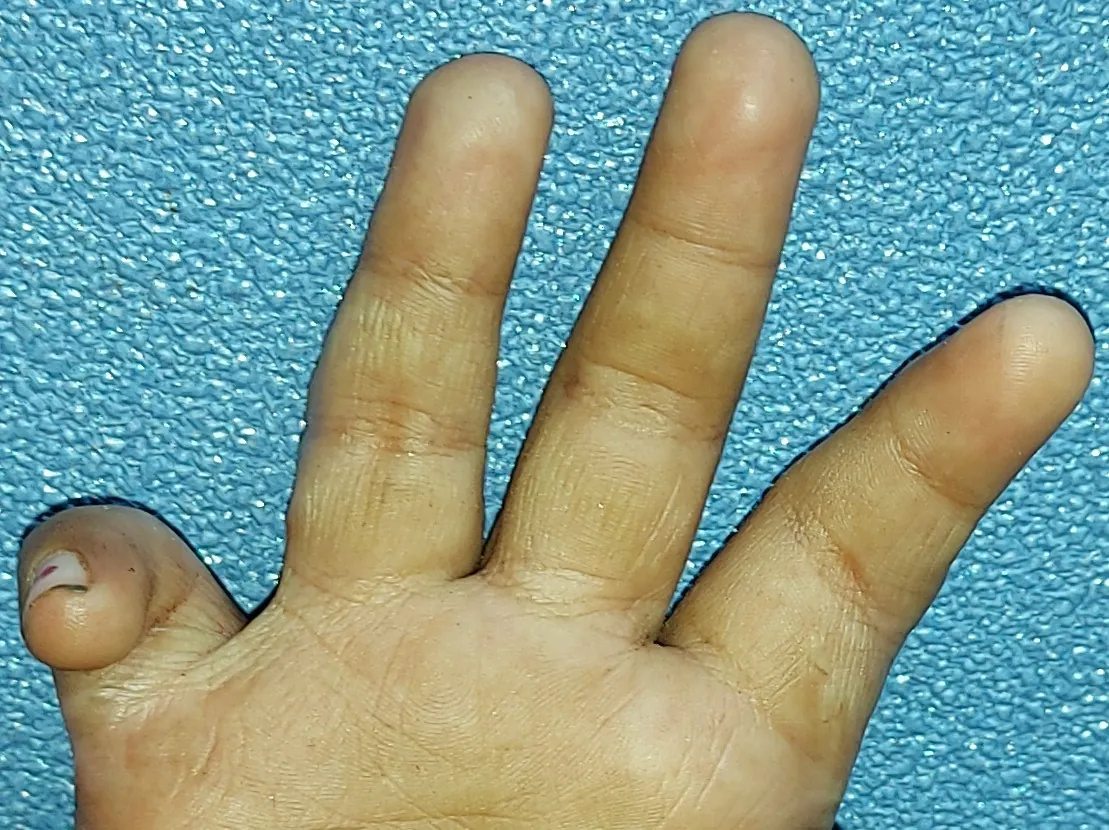 After surgery