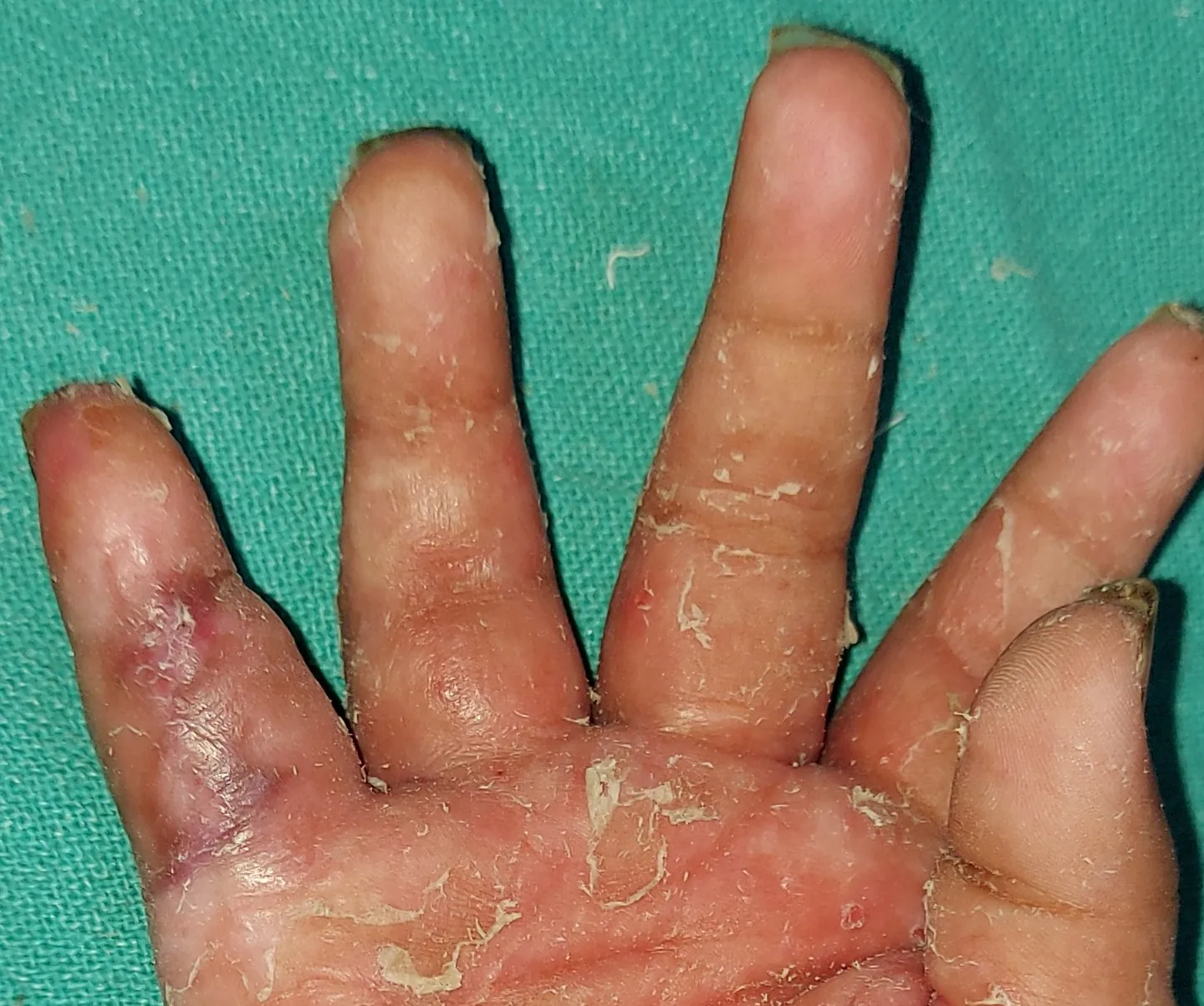 Before surgery