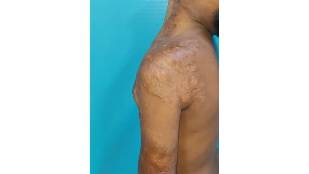 After surgery