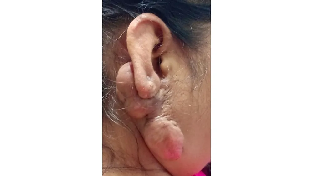 Burn Keloid Scar — before