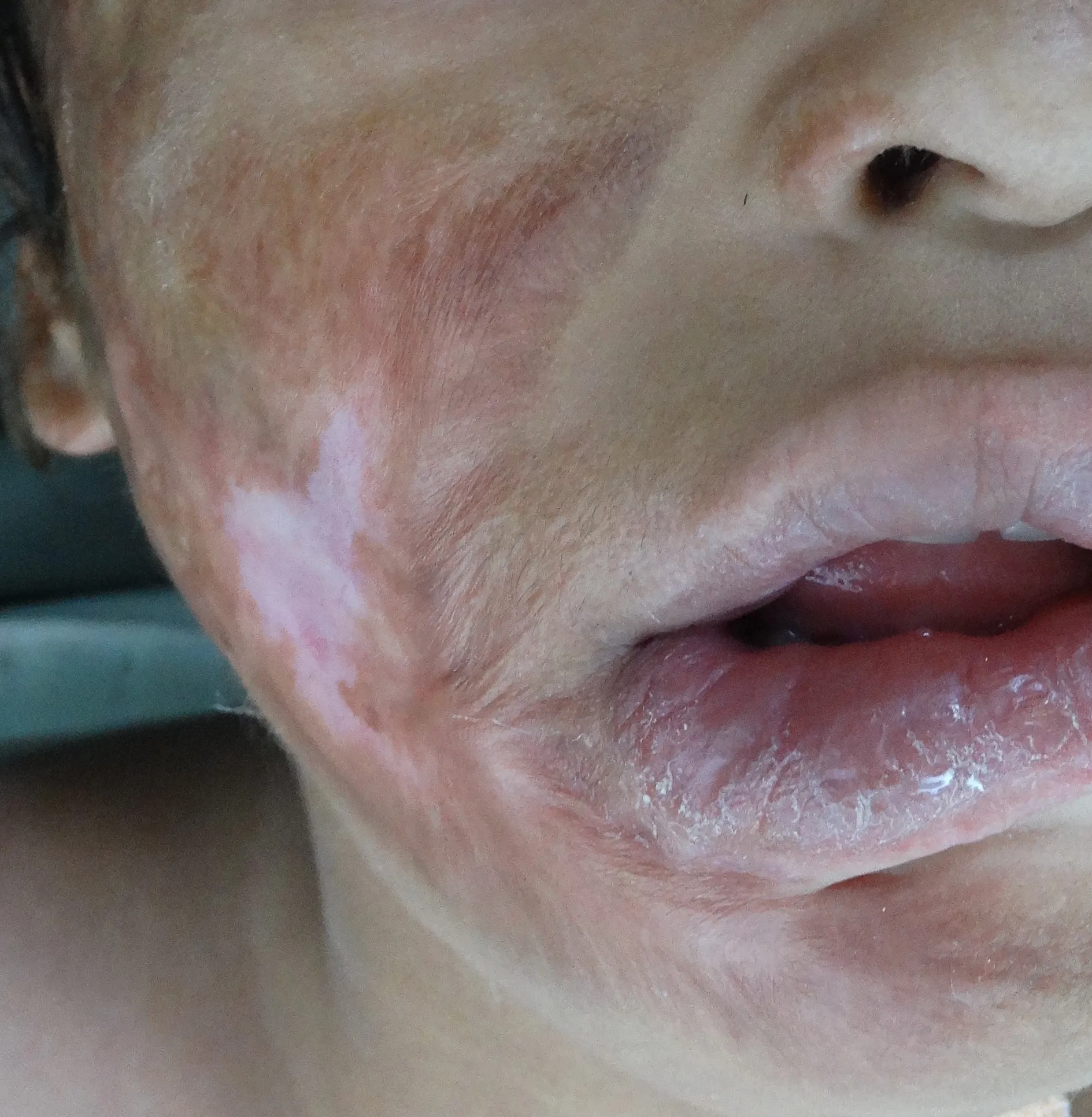 Burn Keloid Scar — before