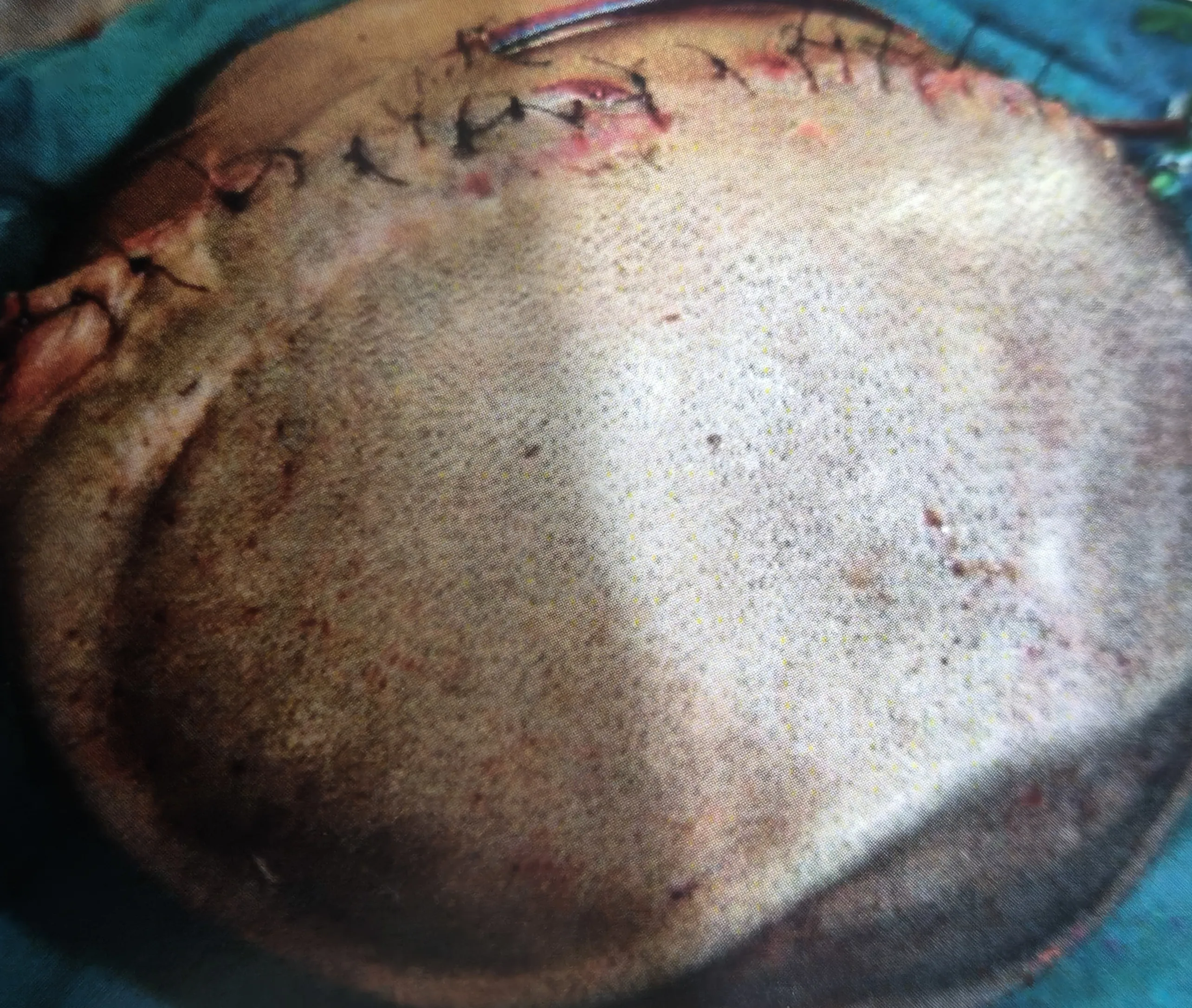 After surgery