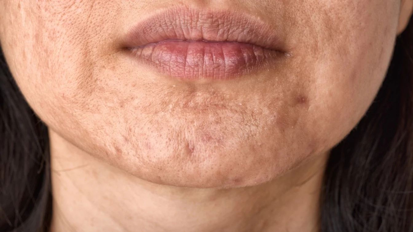 Burn Scars on The Face — hero image