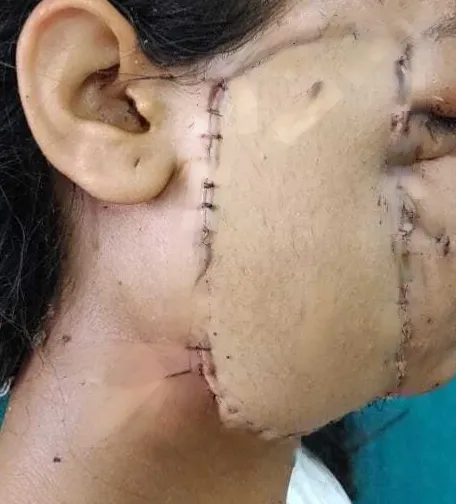After surgery
