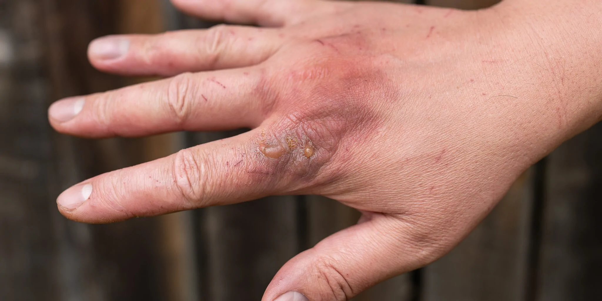 Burn Wounds — hero image