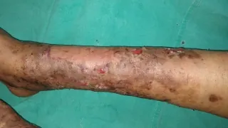 After surgery