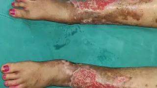 Before surgery